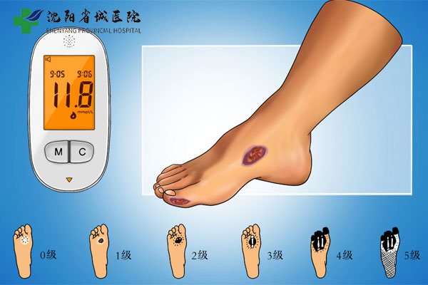 沈阳糖尿病手术是真的吗?哪家医院好? 沈阳糖尿病手术是真的吗?哪家医院好?
